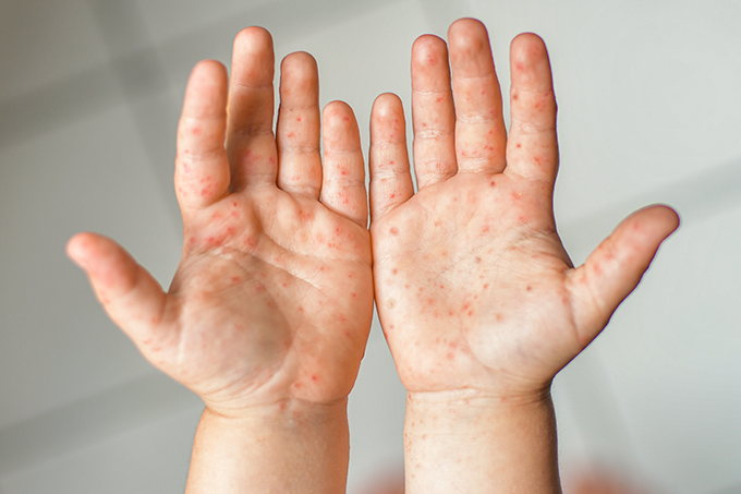 Doença mão-pé-boca: o que é, diagnóstico, sintomas e tratamento